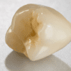UTZirc 100% Zirconia - Image 2