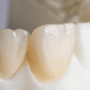 UTZirc 100% Zirconia