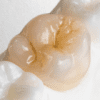 UTZirc 100% Zirconia - Image 3
