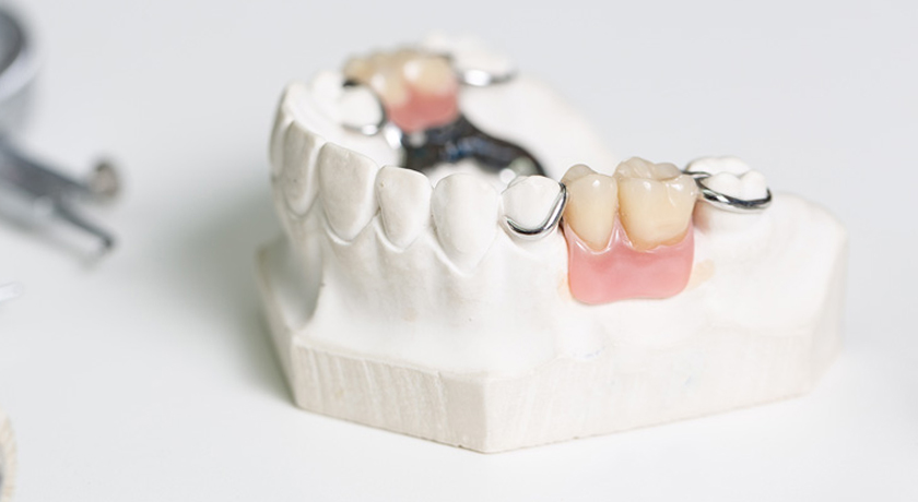 Cast Partial Framework | Dental Directory Australia
