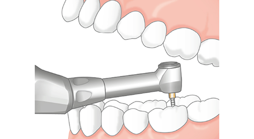 NSK ENDO-MATE TC2 - Image 3