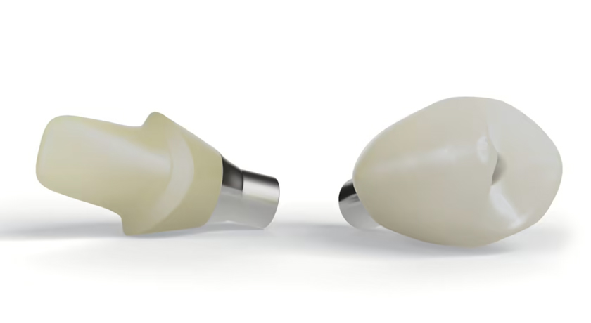IPS e.max Press Abutment Solutions - Image 2