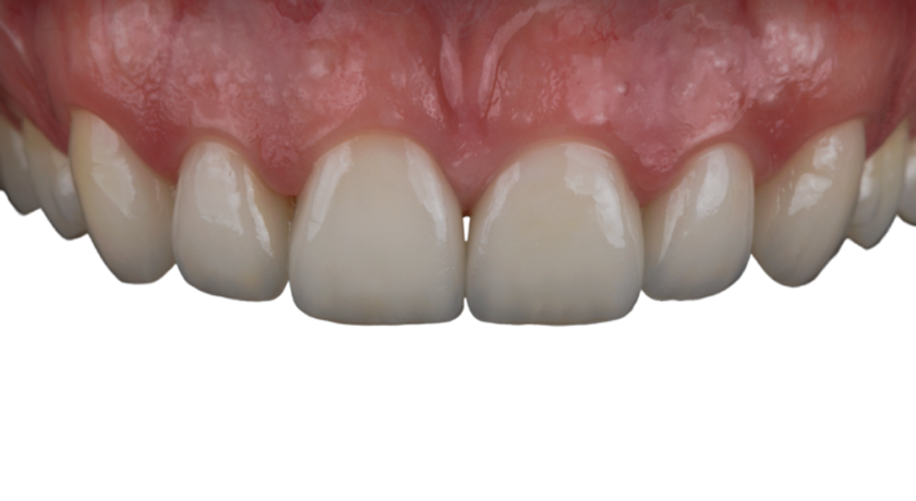 Zirlux Esthetic TR - Zirconia Disc - Image 3