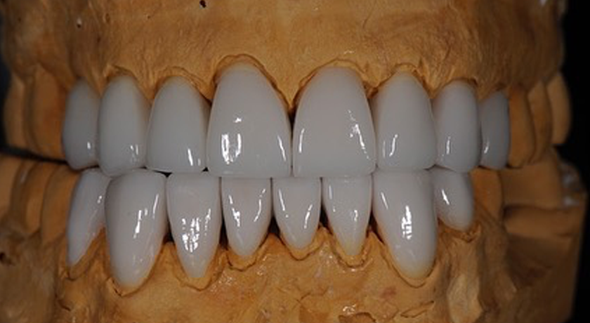 IPS e.Max - Image 2