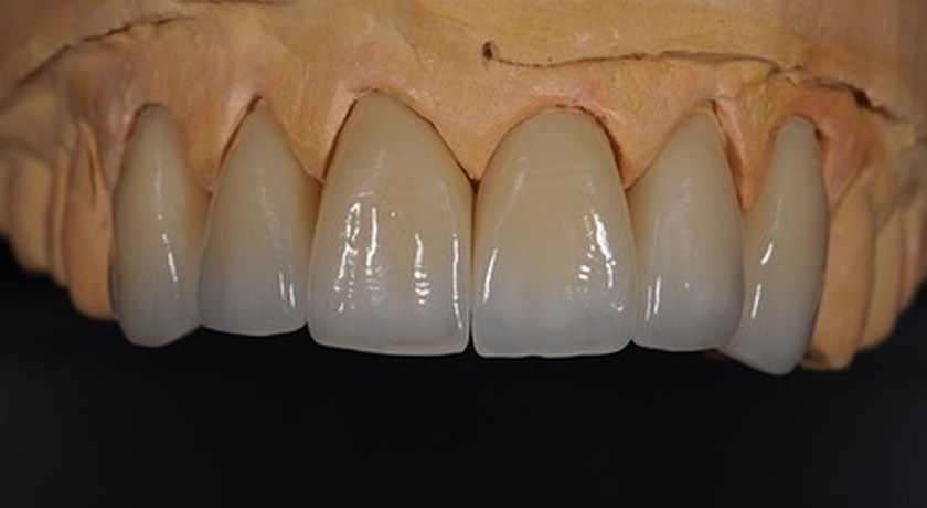 IPS e.Max