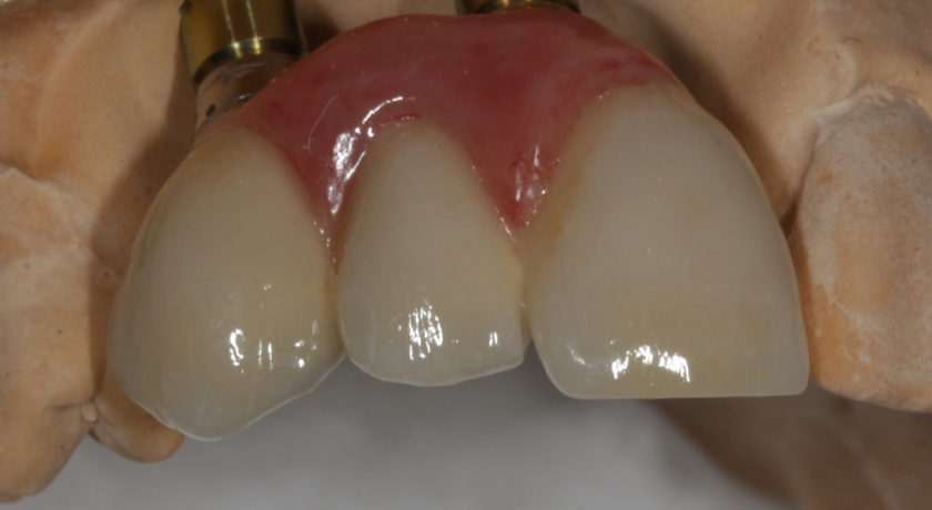 Implant Crowns & Bridges - Image 2