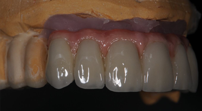 Implant Crowns & Bridges