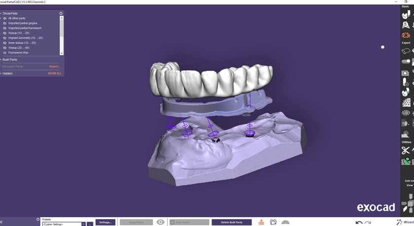 Implant Restorations