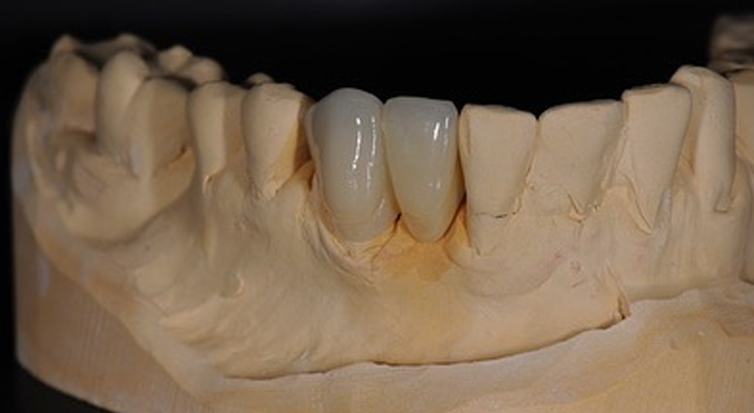 Porcelain Fused to Metal - Image 3