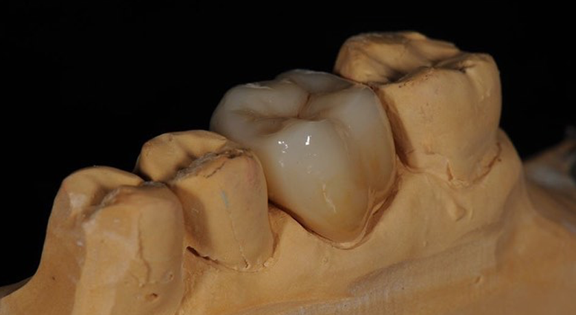 Porcelain Fused to Metal - Image 2
