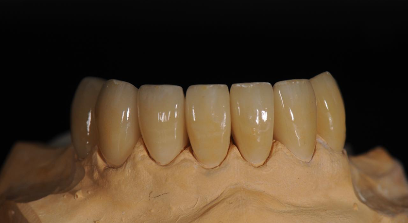 Porcelain Fused to Metal | Dental Directory Australia