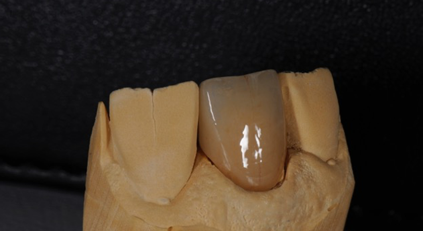 UT Zirconia Monolithic | Dental Directory Australia